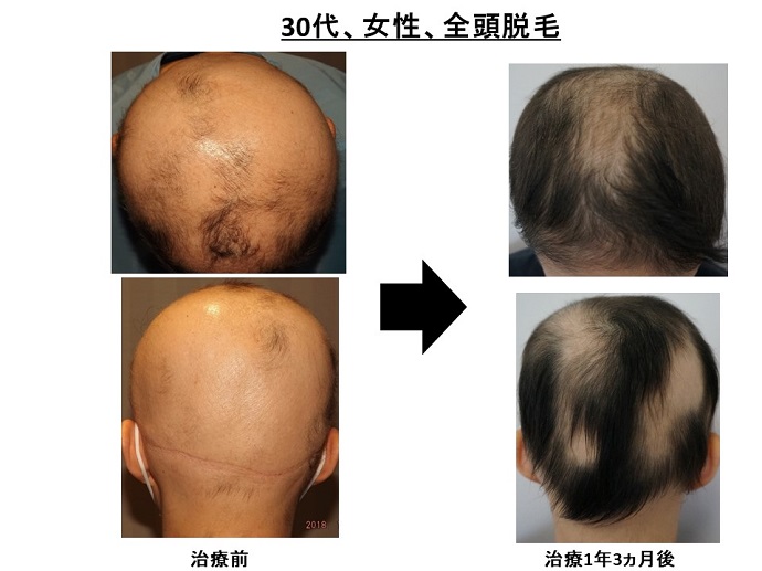 円形脱毛症　病院